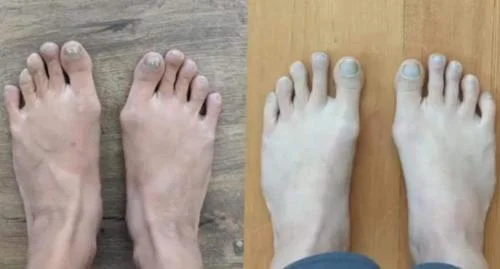 Voor en na resultaat: scheve tenen vóór en rechte tenen na het gebruik van de TeenCorrector